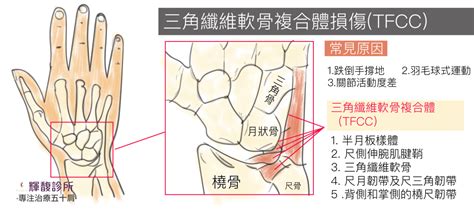 手受傷|三角纖維軟骨（tfcc）受傷怎麼治療？手腕軟骨受傷多久會好？ ∣